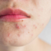 METHODS TO GET RID OF ACNE SCARS