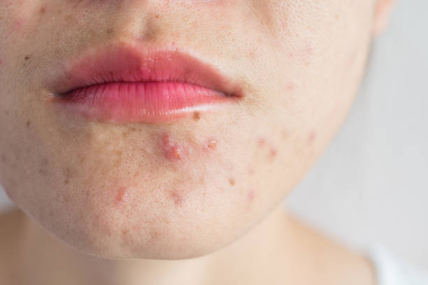 METHODS TO GET RID OF ACNE SCARS