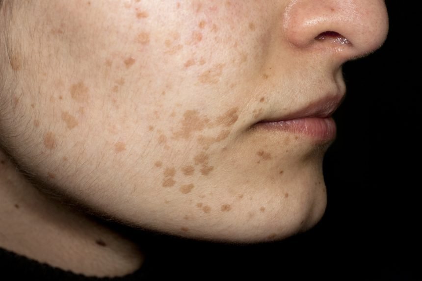 HPV: What is this infection?