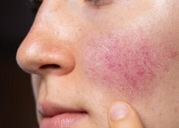 Top 6 Ways to Minimize Your Rosacea Flare-Ups