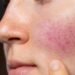 Top 6 Ways to Minimize Your Rosacea Flare-Ups