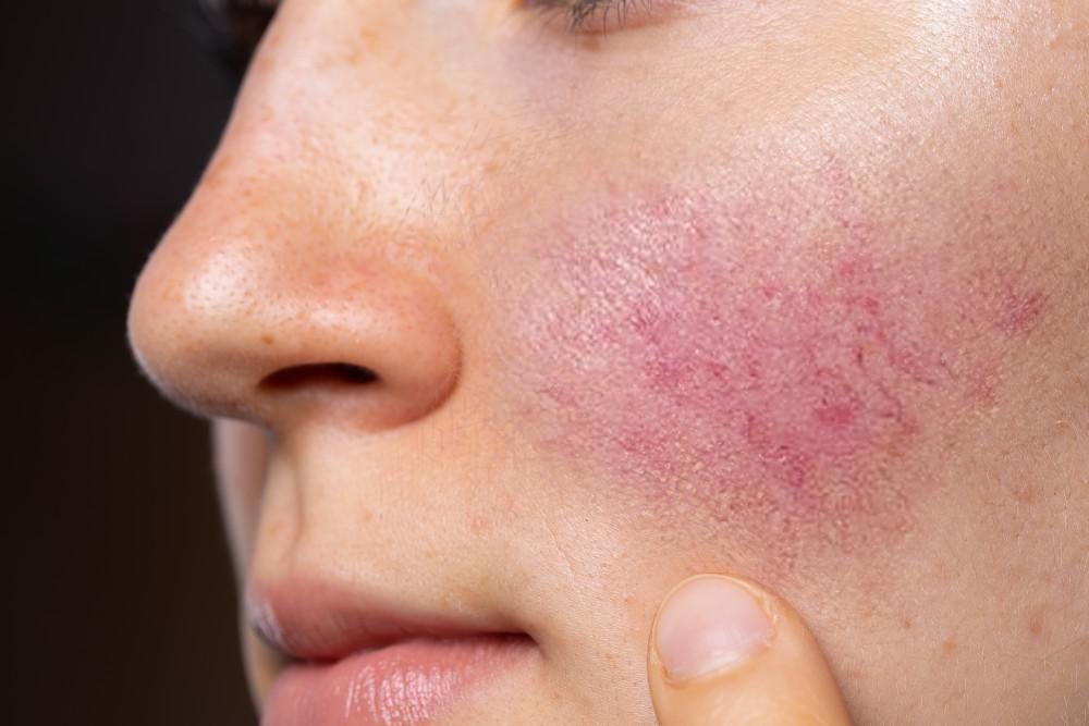 Top 6 Ways to Minimize Your Rosacea Flare-Ups