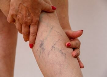 Keeping Your Veins Healthy- What to Do and Avoid?