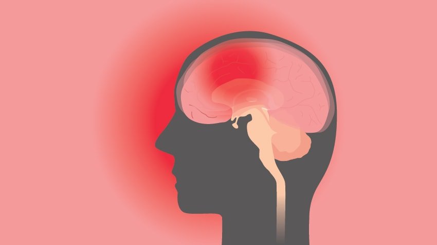 Concussion; The Facts