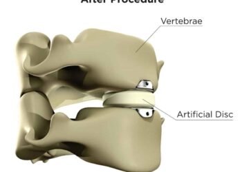 What Happens During And After Cervical Total Disc Replacement?