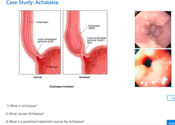 Achalasia
