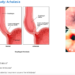 Achalasia