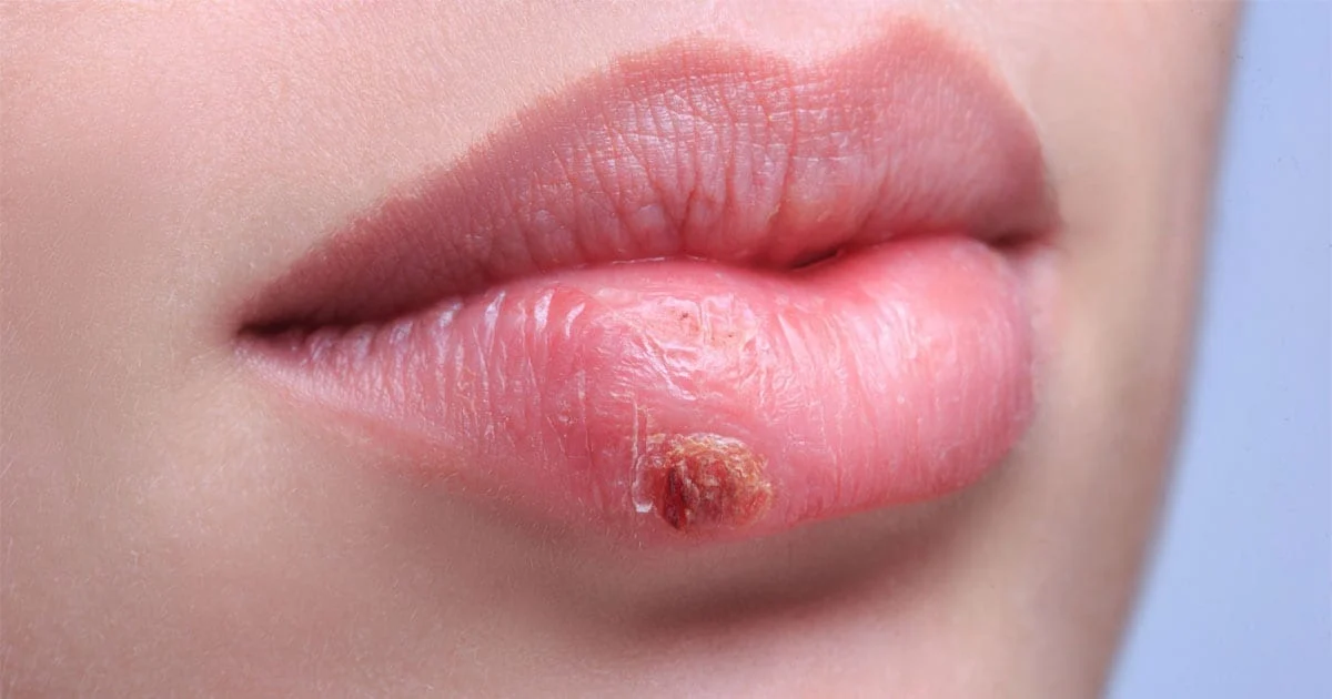 Over-The-Counter Genital Herpes Treatment Options