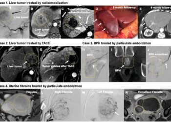 Radioembolization Y-90 Farmington