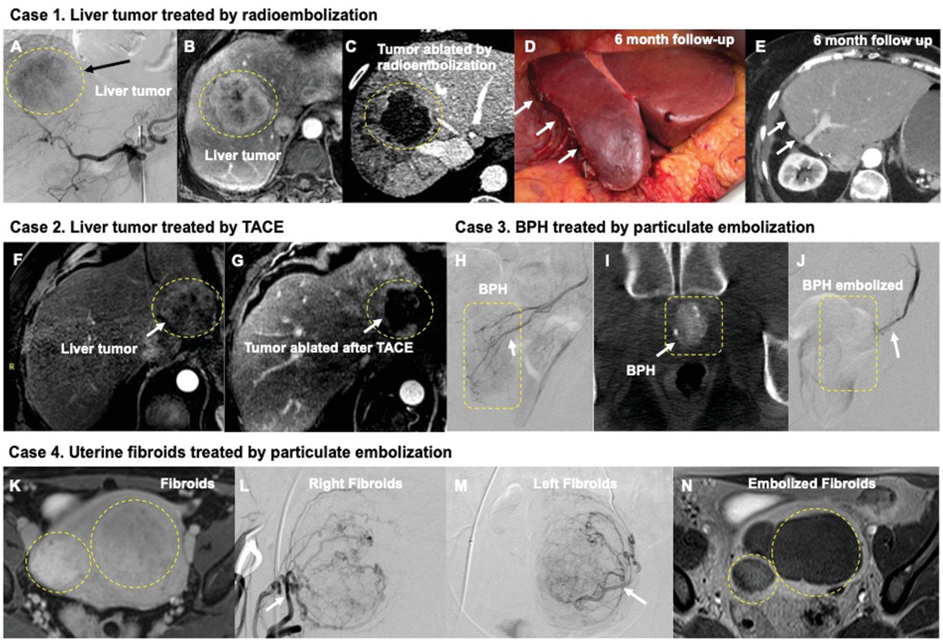 Radioembolization Y-90 Farmington