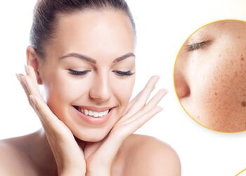 Hyperpigmentation treatment