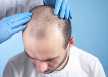 Should You Get a Hair Transplant in Dubai?