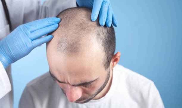 Should You Get a Hair Transplant in Dubai?