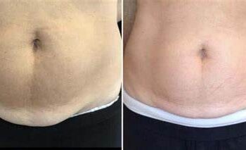 liposuction in Chandigarh