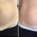liposuction in Chandigarh