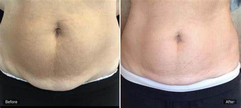 liposuction in Chandigarh