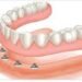 implant retained dentures