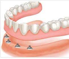 implant retained dentures
